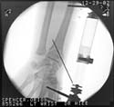 oj_wrist04